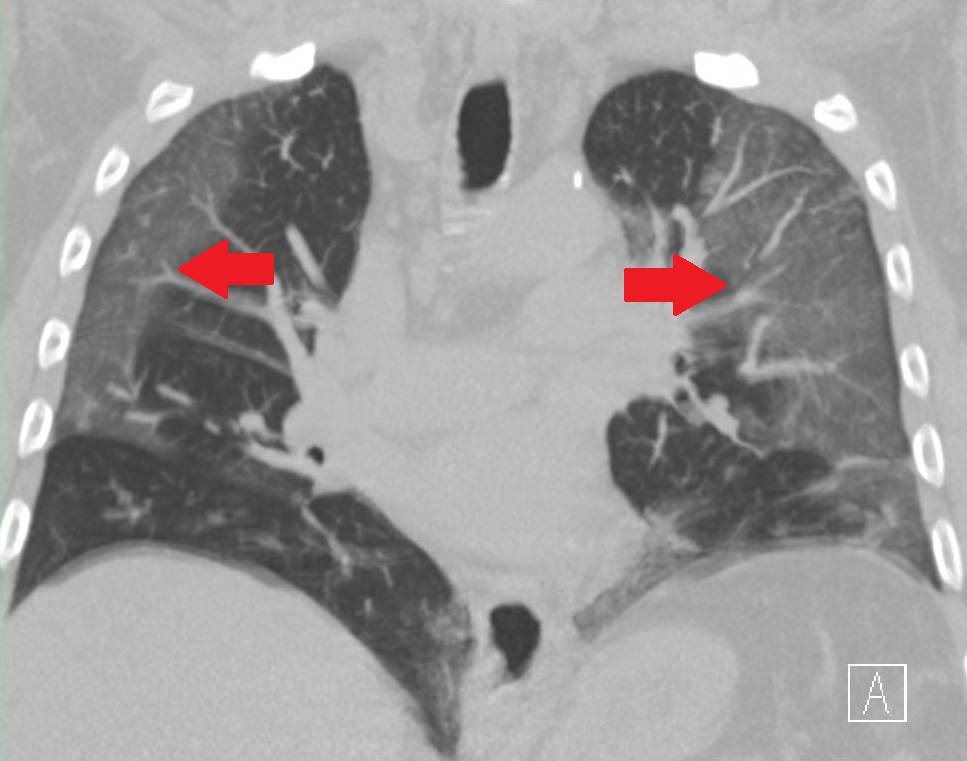 Beeld van een longontsteking bij een COVID-19-infectie